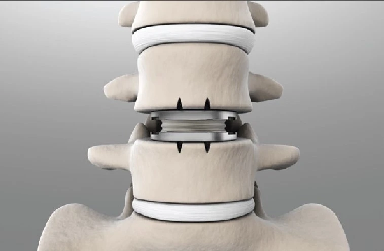 Best-lumbar-disc-doctor-Tehran