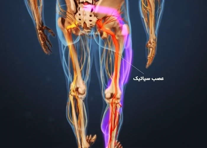 Early-treatment-right-leg-sciatica