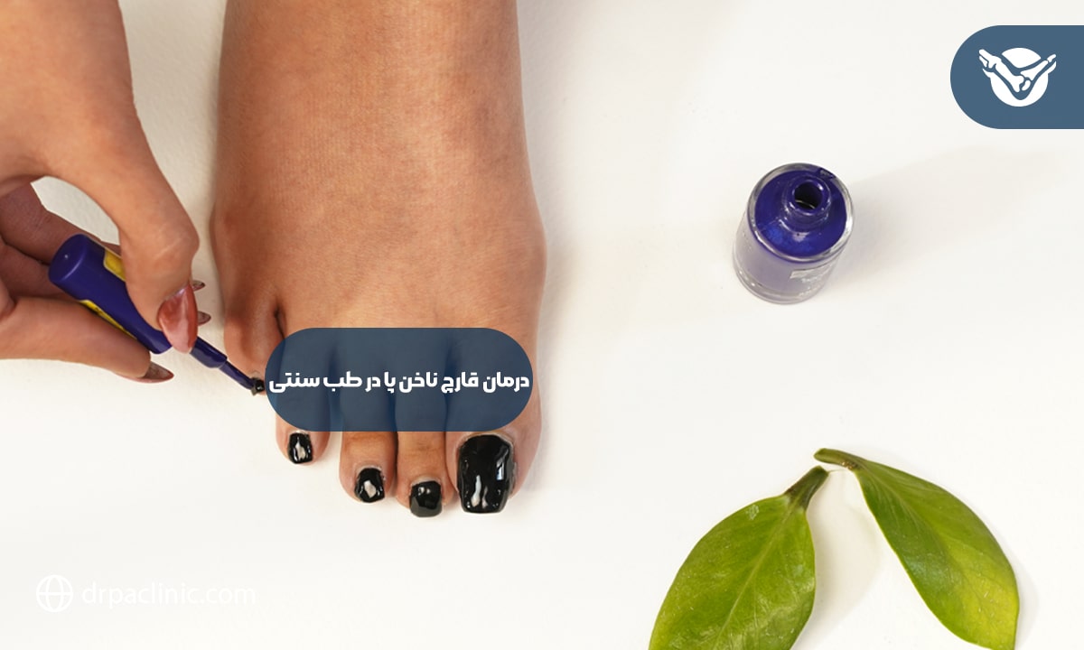 نکات کلیدی درمان قارچ ناخن پا در طب سنتی
